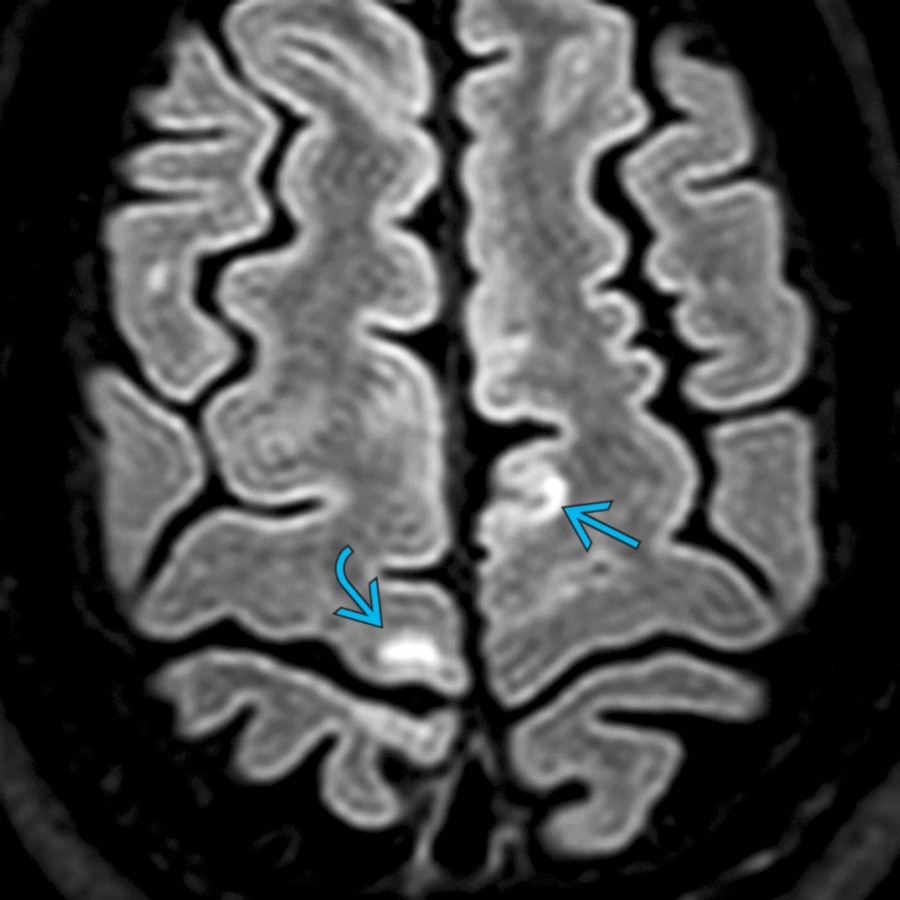 Axial FLAIR MR shows subcortical  and cortical  demyelinating MS plaques. Cortical lesions are better seen at higher field strength MR and are classified as leukocortical [inner aspect of cortex ± involvement of juxtacortical white matter (WM)], intracortical (purely within cortex), and subpial (involving outer aspect of cortex).