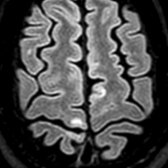 Axial FLAIR MR shows subcortical  and cortical  demyelinating MS plaques. Cortical lesions are better seen at higher field strength MR and are classified as leukocortical [inner aspect of cortex ± involvement of juxtacortical white matter (WM)], intracortical (purely within cortex), and subpial (involving outer aspect of cortex).