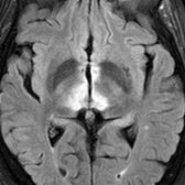 Axial FLAIR MR in a patient with NMOSD shows characteristic periependymal lesions surrounding the 3rd ventricle, involving the thalamus  and hypothalamus .