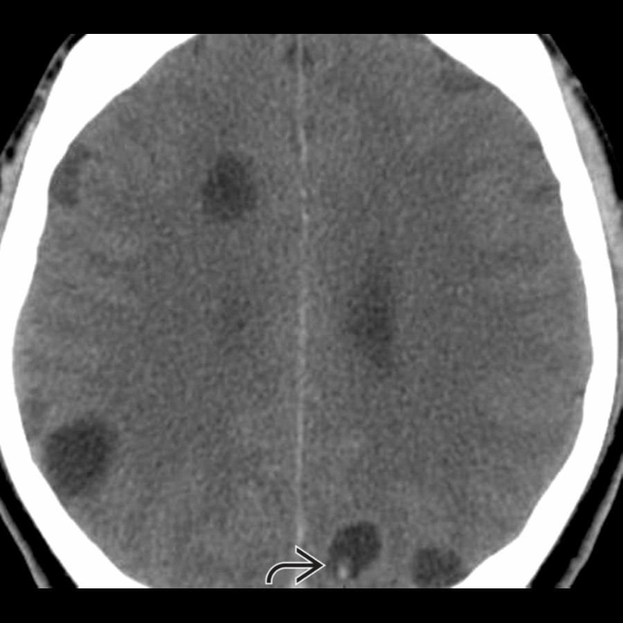 Axial CECT shows bilateral frontoparietal nonenhancing cysts without edema. One left parietal lobe cyst shows hyperdense scolex , suggesting NCC vesicular stage.