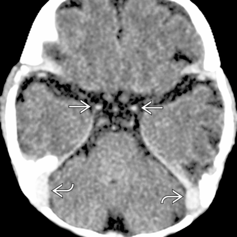 Axial NECT demonstrates relatively hyperdense internal carotid arteries  in this neonate. Note the corresponding ↑  density of the transverse sinuses .