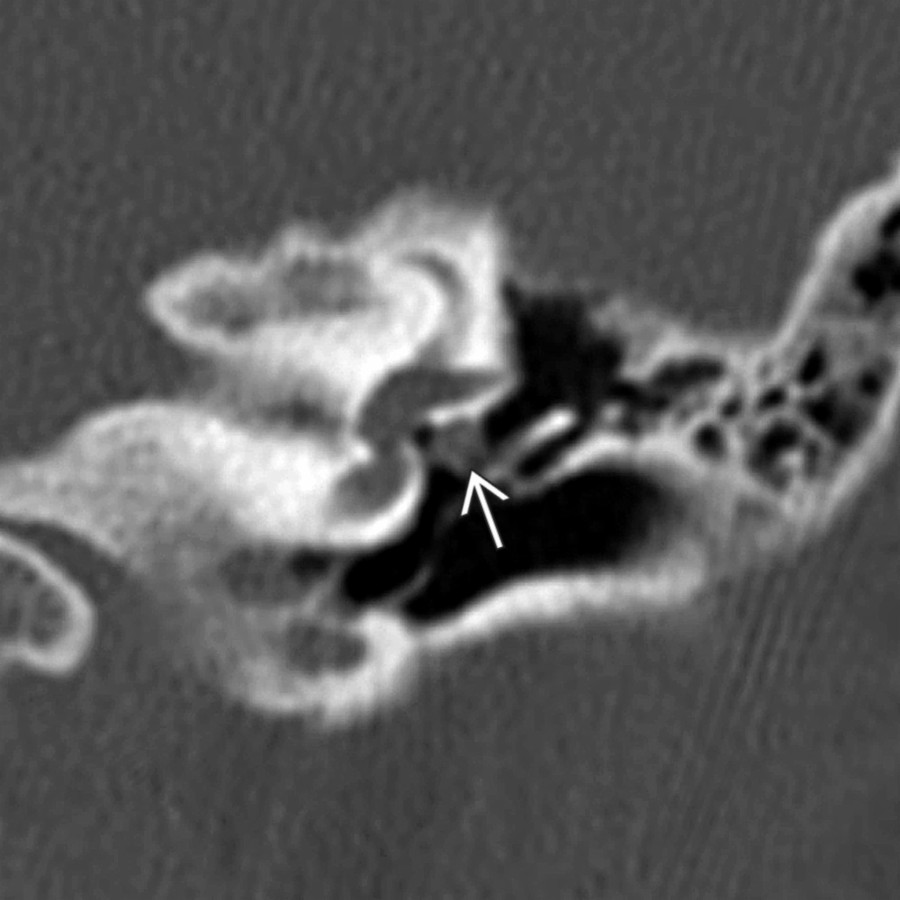 Coronal left ear temporal bone CT shows the enlarged, prolapsed tympanic segment of CNVII in cross section . Enhanced MR can differentiate protrusion of CNVII (no enhancement) vs. facial nerve schwannoma (enhancement).