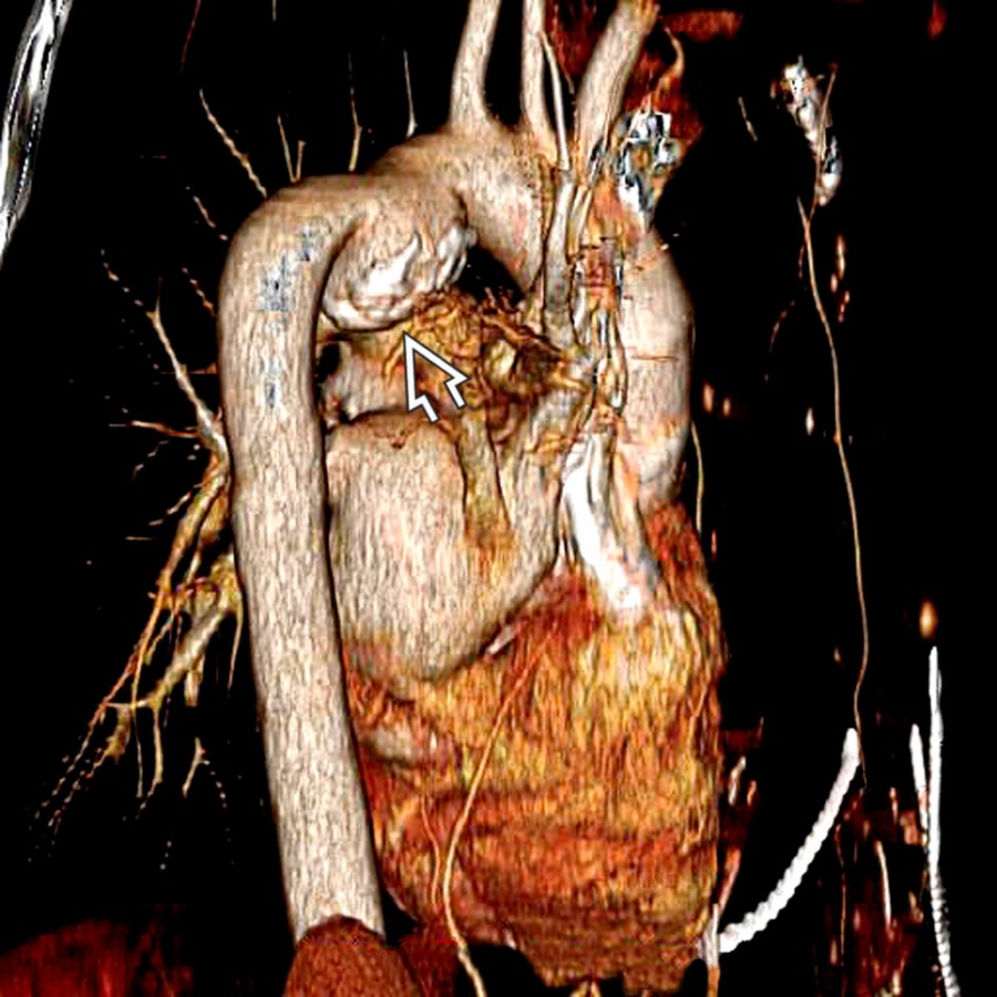 Posterior sagittal chest 3D reformation in the same patient demonstrates the aortic pseudoaneurysm  and its relationship with the pulmonary artery and the left atrium. 3D reformations may be helpful for better anatomic understanding and appropriate surgical planning.
