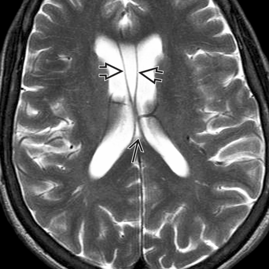 Axial T2 MR shows a cavum septi pellucidi (CSP)  along with a very small cavum velum interpositum . Note that these 2 unrelated lesions do not communicate with each other. It is common to see a CSP with a cavum vergae; it is rare to see a CSP and a CVI in the same patient.
