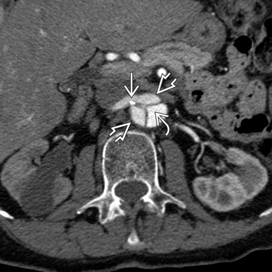 Axial CTA shows abdominal aortic dissection with Mercedes-Benz sign  relating to a triple-channel dissection resulting in 2 false lumina . One of the 2 intimal flaps extends to the origin of the right renal artery .