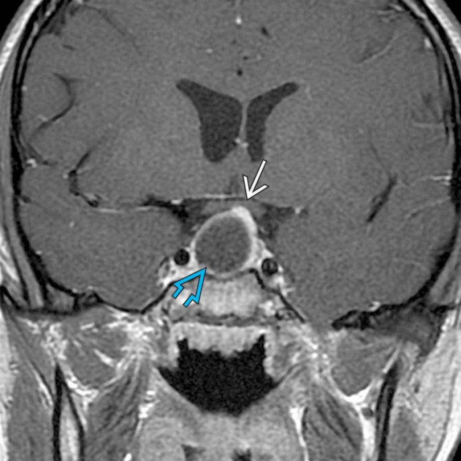 Coronal T1 C+ MR shows a cystic macroadenoma  with mild mass effect on the left optic chiasm . Imaging in this young adult female with amenorrhea and markedly elevated prolactin mimics a Rathke cleft cyst.