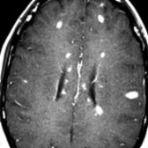 Axial T1WI C+ MR shows numerous enhancing MS plaques that were present throughout the infratentorial and supratentorial brain. Lesions may show homogeneous enhancement but may also exhibit ring or an incomplete ring pattern of enhancement.