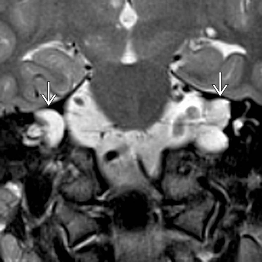 Coronal T2 FSE MR shows a patient with CSF dissemination of glioneuronal neoplasm. The hyperintense tumor filling the widened IACs  is hard to distinguish from CSF on this image but was more evident on FLAIR images. The patient had large IACs at the time of presentation. As CSF tumor dissemination/metastatic disease occurred, the IACs showed progressive massive enlargement over time on successive MR studies.
