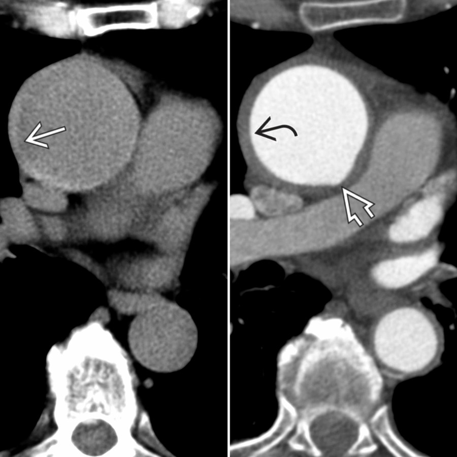 Axial chest NECT and CTA in a patient with incomplete dissection show crescentic hyperdensity  and thickening  along the ascending aorta, findings identical to those seen in IMH. Note the discrete bulging  along the posterior ascending thoracic aorta, distal to the origin of the left coronary artery. This characteristic finding is classically seen in incomplete aortic dissection.