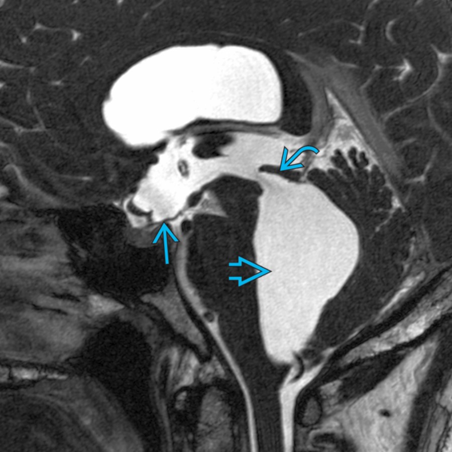 Sagittal CISS MR in a patient with obstruction at the 4th ventricular outlet due to adhesions shows ballooning of the 4th ventricle , widening of the aqueduct of Sylvius , dilated 3rd and lateral ventricles with downward sloping of 3rd ventricular floor .