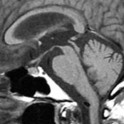 Midline sagittal T1WI of 65-year-old man with progressive supranuclear palsy shows asymmetric atrophy of the midbrain. Slight concave appearance of the superior surface of the midbrain  (penguin or hummingbird sign) and atrophy of the superior colliculus   is shown.