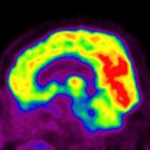 Sagittal FDG PET in the same patient with FTD depicts glucose hypometabolism in the frontal lobes . The occipital lobes  are normal.
