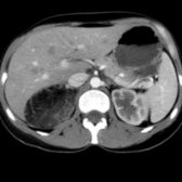 Axial CECT in the same patient confirms a fat-attenuation suprarenal mass . Extrarenal angiomyolipoma was ultimately resected. The differential diagnosis of large myelolipomas includes retroperitoneal liposarcomas, angiomyolipomas, and adrenal carcinomas with lipomatous metaplasia.