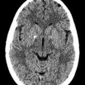 Axial NECT shows focal globus pallidus calcification  bilaterally. The CT appearance of PKAN is variable. Globus pallidus may be hypodense or hyperdense secondary to dystrophic calcification, as seen in this case.
