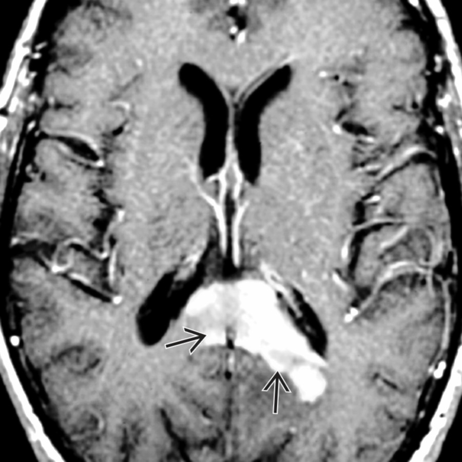 Axial T1 C+ MR shows a primary CNS lymphoma involving the splenium of the corpus callosum. There is avid, solid enhancement of the tumor  with extension into the adjacent parenchymal white matter.