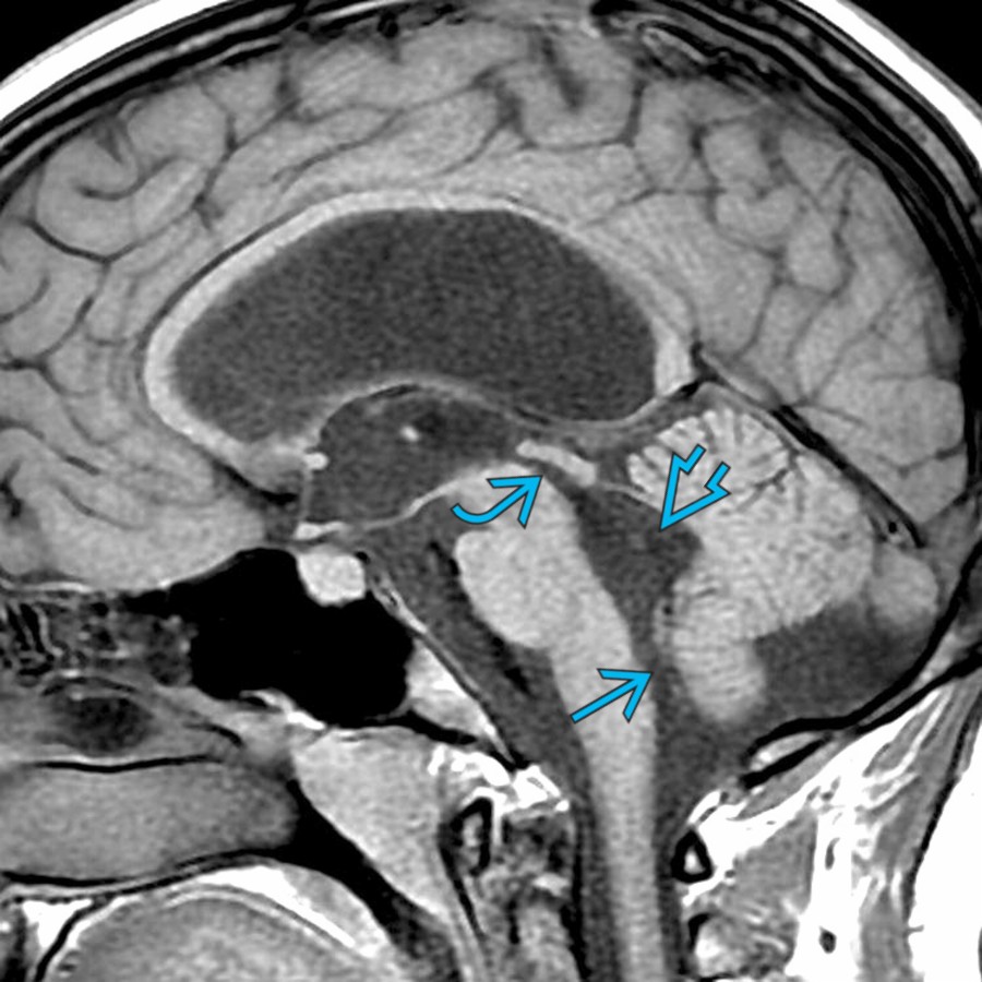 Sagittal T1 MR in the same patient shows a patent widened cerebral aqueduct  and foramen of Magendie  with dilatation of the 4th ventricle . In longstanding "compensated" hydrocephalus, there is no periventricular interstitial edema around the ventricles, as in this case.