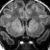 Coronal T1 MR demonstrates 2 normal-sized pituitary glands  laterally displaced within the abnormal skull base. The glands are uniformly hyperintense due to maternal hormonal influences. The pituitary gland is normally diffusely hyperintense on T1 MR in newborns.