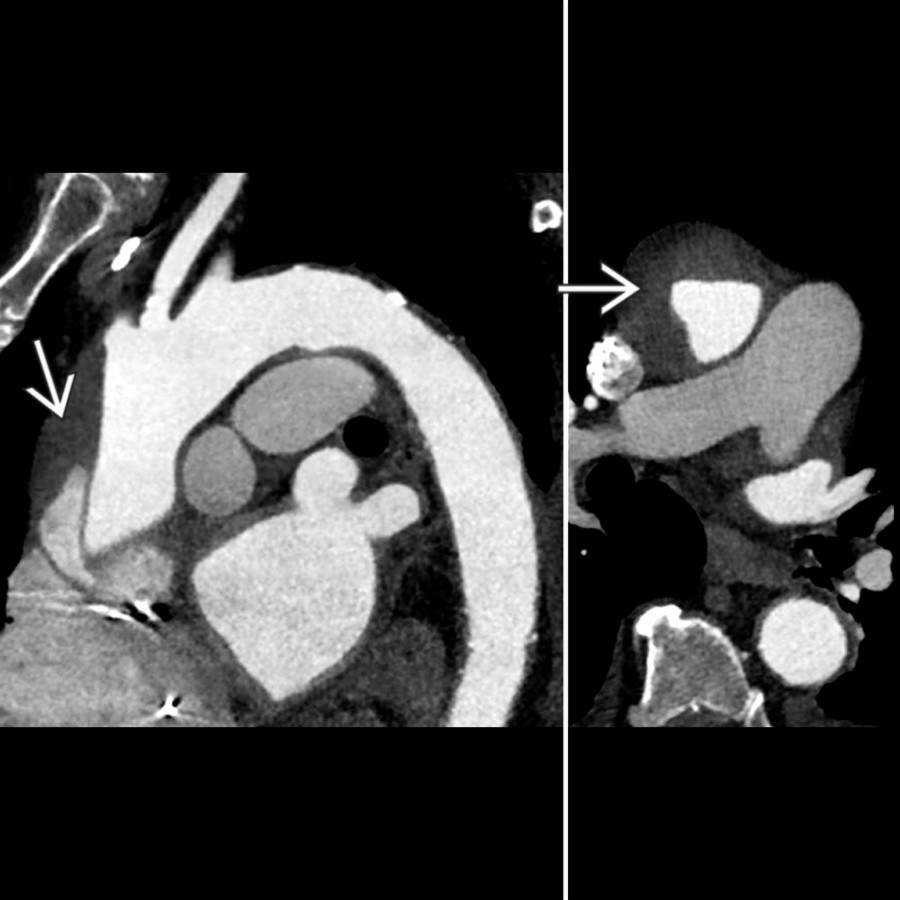 "Candy cane" sagittal oblique (left) and axial (right) CTA views show Stanford type A aortic dissection with partially thrombosed false lumen .