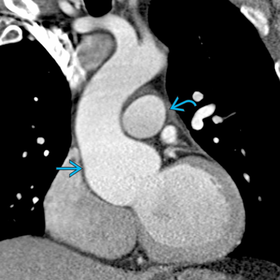 Coronal CECT in the same patient shows effacement of the sinotubular junction , which is characteristic of MFS. Note diffuse dilatation of the entire ascending thoracic aorta, demonstrating a morphology often referred to as the tulip bulb sign. The pulmonary trunk  appears smaller than the aorta. Normally, the pulmonary artery is of the same size as the ascending aorta.