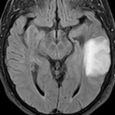 Axial FLAIR MR in a 71 year old with altered mental status shows abnormal hyperintensity in the left temporal lobe  . Differential considerations include infectious, inflammatory, and neoplastic etiologies. GAD65 AE was diagnosed at brain biopsy.