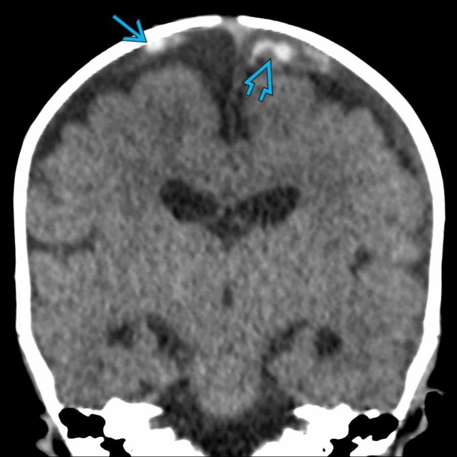 Coronal NECT in a 3-month-old with ABT  shows focal areas of parasagittal hemorrhage . The lesion on the left has a lollipop or pollywog  appearance, typical for cortical vein avulsion, a finding that is fairly specific for AHT.