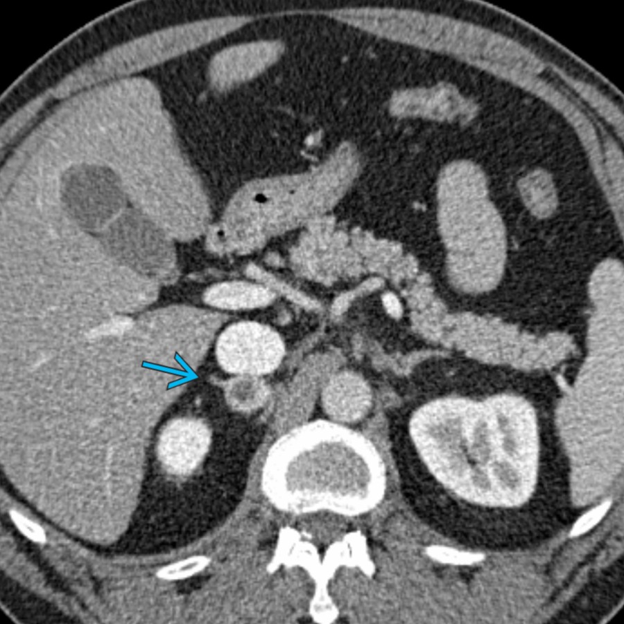 Axial CECT in a 44-year-old man with hypertension shows an incidental right adrenal mass   following motor vehicle collision. The mass was resected via right posterior retroperitoneoscopic adrenalectomy and pheochromocytoma was confirmed.