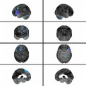 Brain surface rendering of F-18 FDG PET of the brain in a patient with nfvPPA demonstrates statistically significant areas of hypometabolism  within the left inferior frontal lobe relative to an age-matched database.