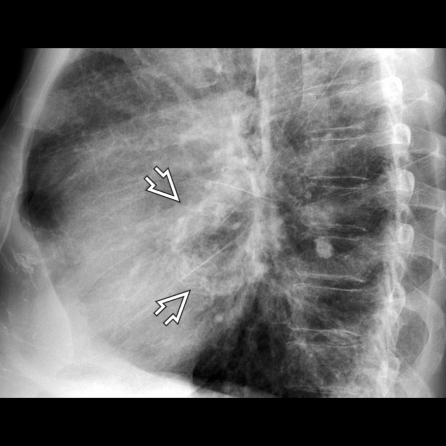 Lateral radiograph shows curvilinear calcification  in the left atrium in a patient with left atrial myxoma.