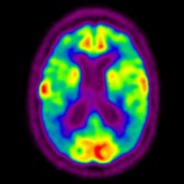 More inferior axial F-18 FDG PET in the patient with late-stage AD shows severe hypometabolism of the posterior parietal  and frontal  cortices. Importantly, there is sparing of the sensorimotor region  and visual cortex .