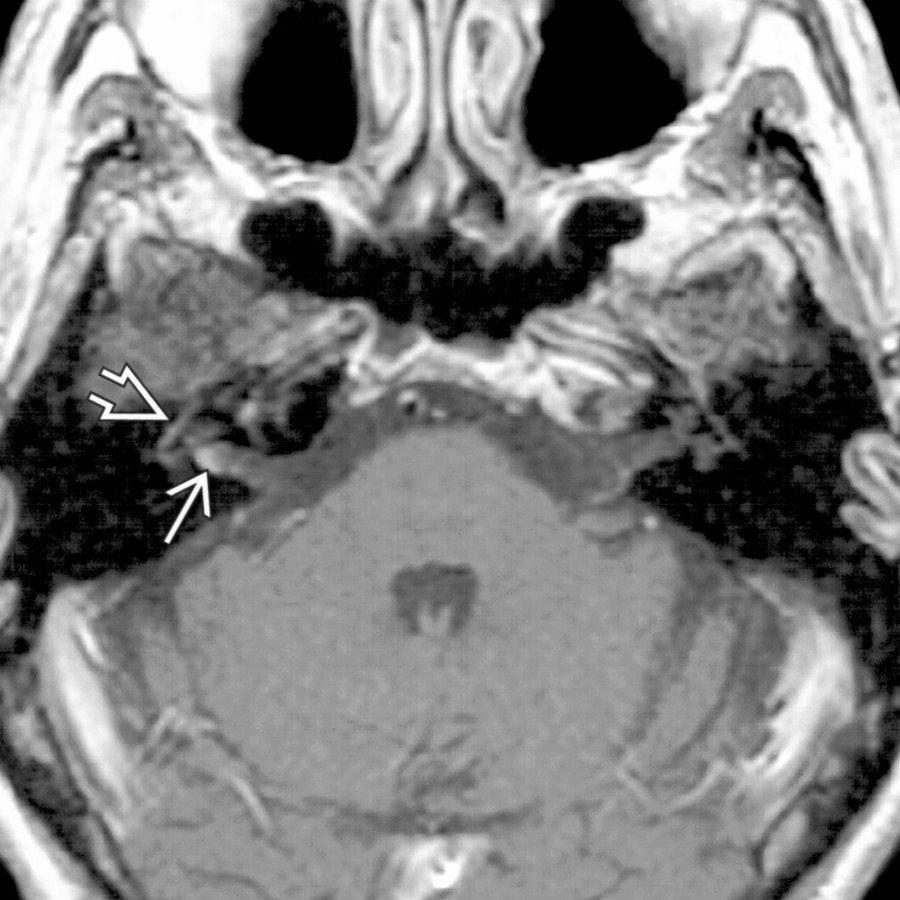 Axial T1 C+ MR shows area of crescentic enhancement in the IAC fundus  associated with tympanic segment of the facial nerve asymmetric enhancement . EAC vesicles were present, characteristic of Ramsey Hunt syndrome.