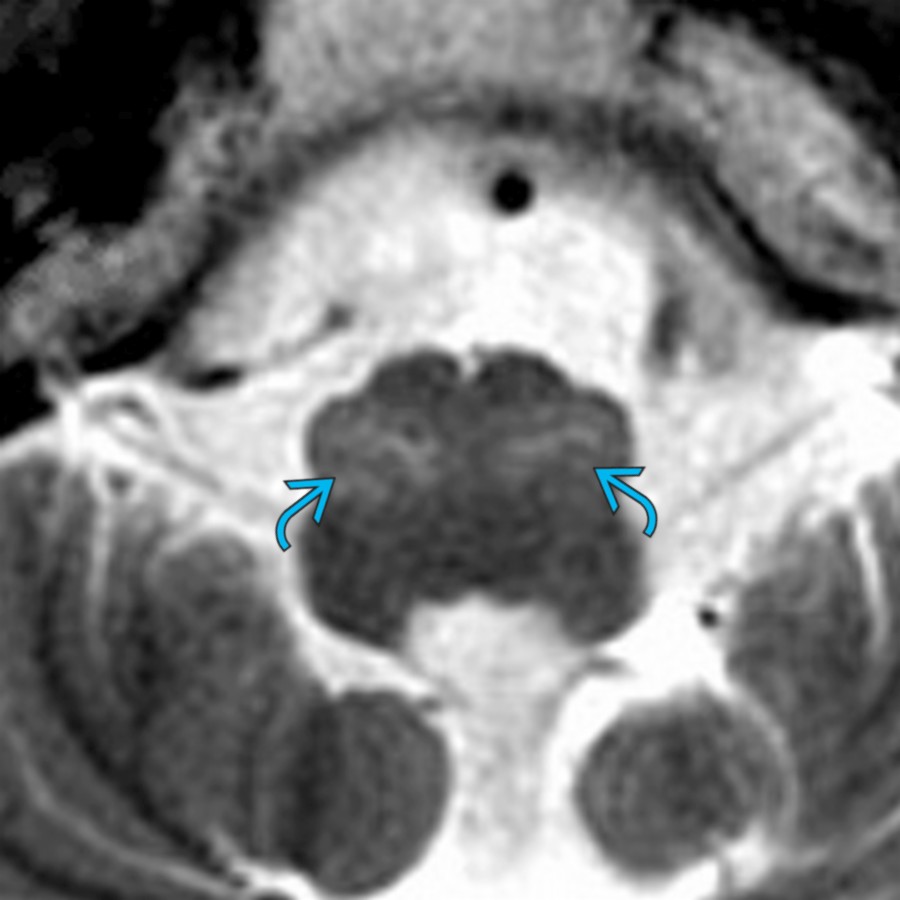 Axial T2 MR in the same patient at the level of medulla shows mild hypertrophy and increased signal involving bilateral inferior olivary nuclei  indicating HOD.
