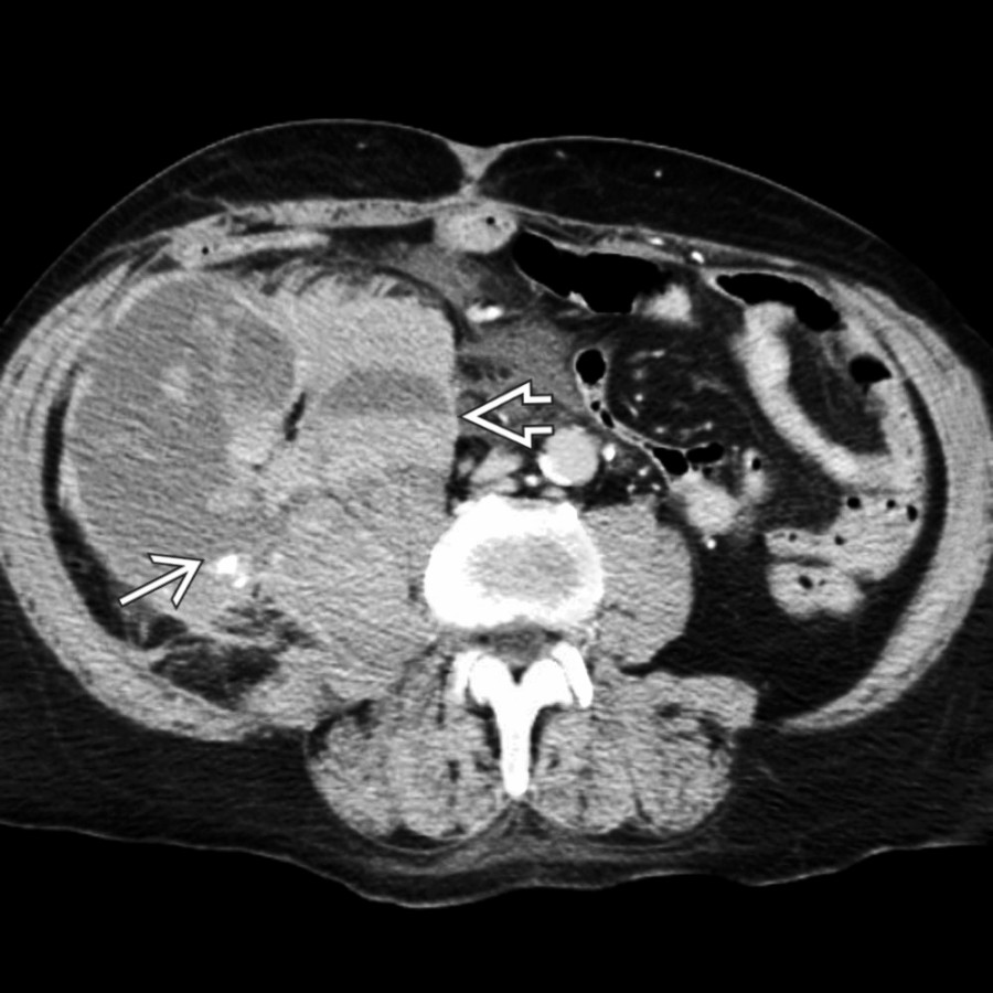 Axial CECT shows a large retroperitoneal mass arising from the iliopsoas compartment. A focus of active bleeding  and hematocrit levels  confirm coagulopathic hemorrhage.