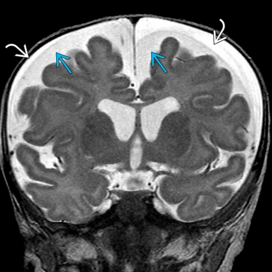 Coronal T2 MR in the same 4-month-old girl with macrocrania shows symmetrically enlarged SAS   as well as small to moderate, bilateral subdural fluid collections . The subdural collections are slightly hyperintense to the SAS. Small subdural fluid collections are seen in ~ 4% of patients with enlarged SAS.