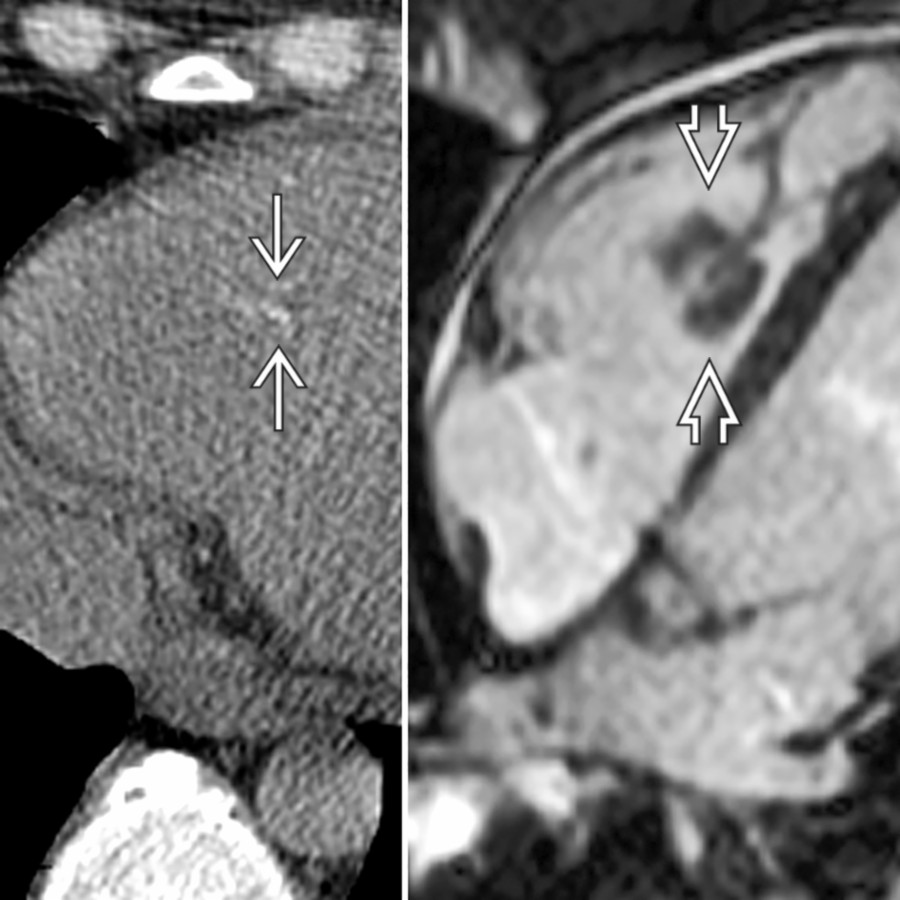 Axial NECT (left) and bright blood MR (right) show a new calcification  in the RV of a 40-year-old patient with remote history of pulmonary embolus. This calcification corresponded to the presence of a chronic thrombus .