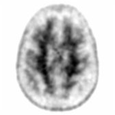 Axial F-18 florbetapir PET shows uptake in the white matter  but no significant uptake in the gray matter , especially in the precuneus , indicating no detectable amyloid deposition, representing a normal scan.