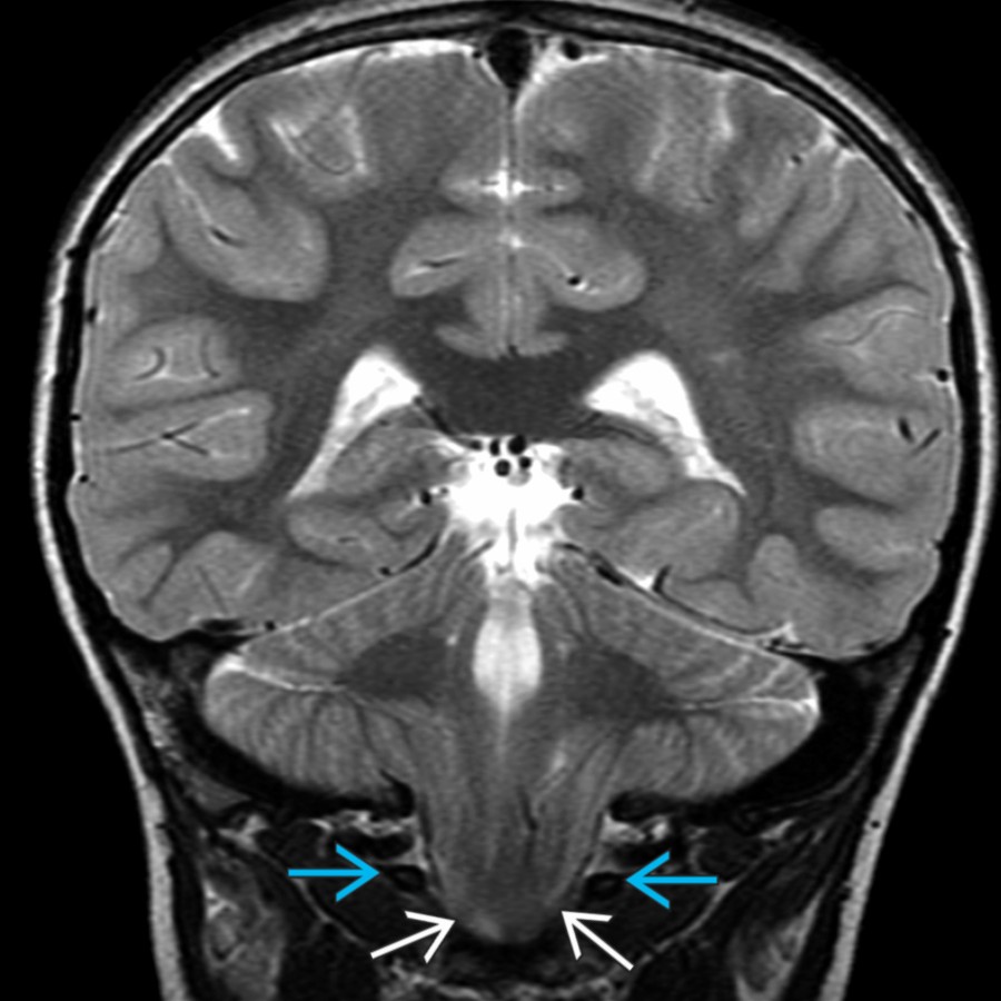 Coronal T2 MR in the same patient demonstrates pointed, low-lying cerebellar tonsils  extending below the C1 ring , typical of CM1.