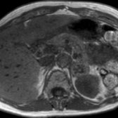 Axial in-phase T1 MR in a 68-year-old woman with colon cancer shows a mildly heterogeneous left adrenal mass .