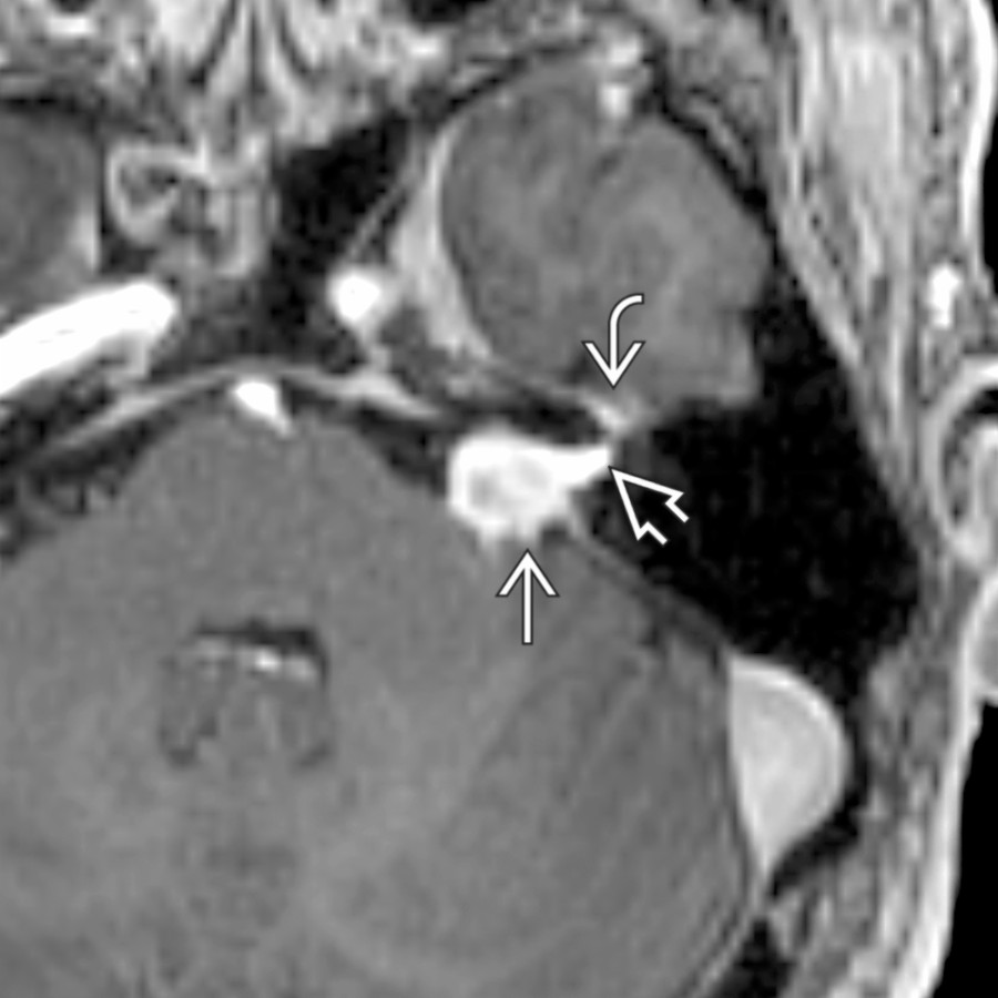 Axial T1 C+ SPGR MR shows a facial nerve schwannoma  involving the left CPA-IAC. In this case, the labyrinthine tail of enhancement  extends to the asymmetrically enhancing geniculate ganglion region , following the expected course of the facial nerve.