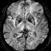 Axial T2* SWI MR demonstrates horizontal linear "waves" of mineralization in the globus pallidi , a normal finding in the aging brain.
