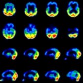 FDG PET in a patient with FTD shows marked hypometabolism in the frontal   & temporal  lobes. There is relative preservation of glucose metabolism in the occipital & parietal lobes .