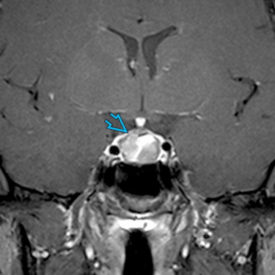 Coronal T1 C+ MR in a 43-year-old woman  with elevated prolactin shows a hemorrhagic intrasellar macroadenoma . Macroadenomas are > 10 mm and most commonly extend through the diaphragma sella into the suprasellar cistern. Displacement of the infundibulum is common.