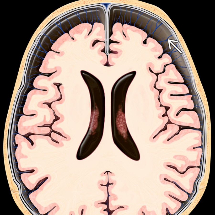 Axial graphic shows classic enlargement of the subarachnoid spaces (SAS) in a macrocephalic infant. There is symmetric bifrontal enlargement of the SAS, which contain multiple bridging veins . Mild ventriculomegaly is present.
