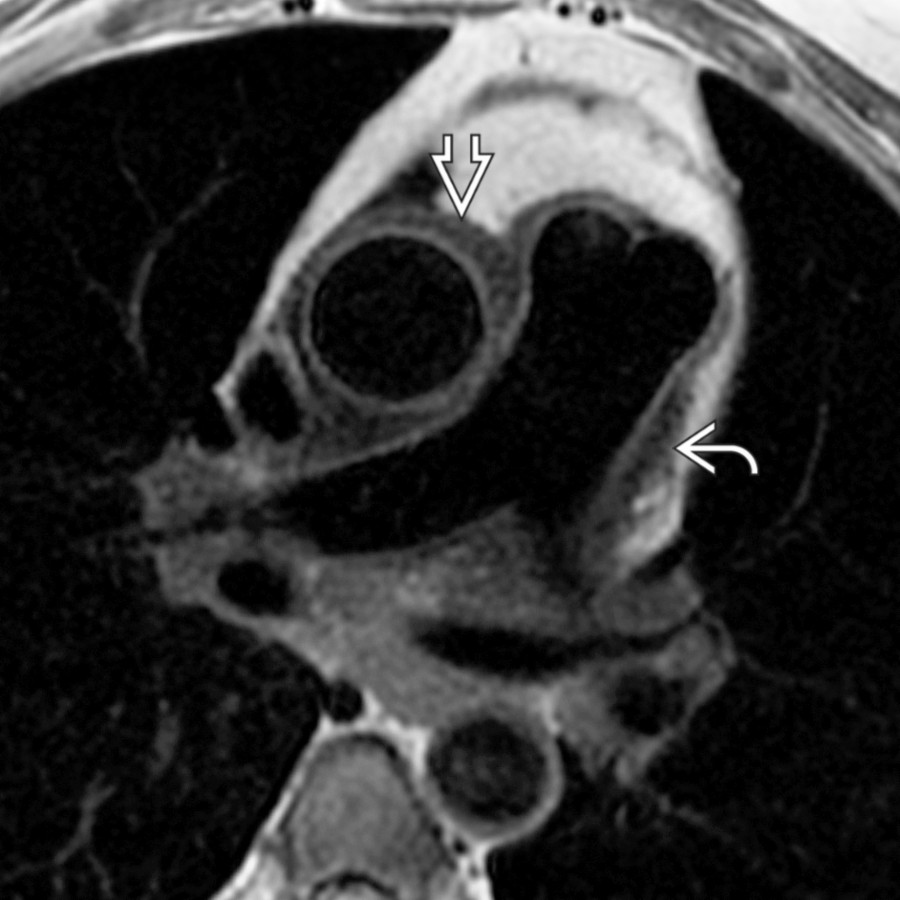 Axial T1 MR in a patient with TA demonstrates thickening of the wall of the ascending thoracic aorta  and the pulmonary trunk . Vessel stenosis, occlusion, and aneurysm formation may complicate cases of TA.