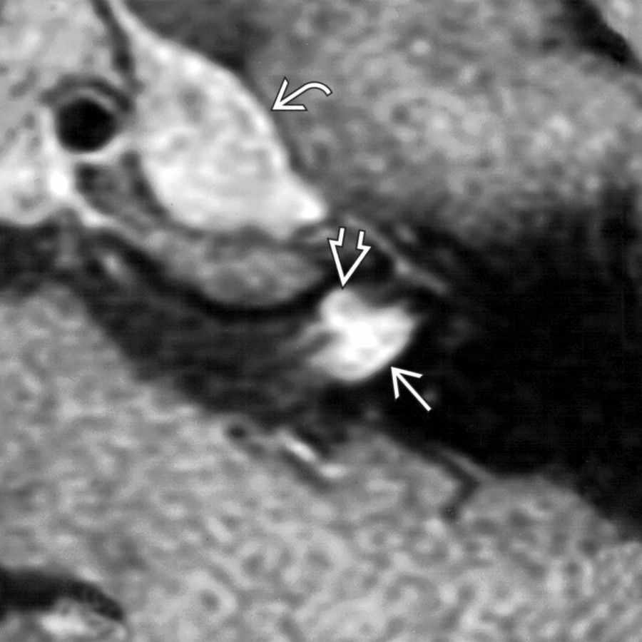Magnified axial C+ FS T1 MR in a patient with neurofibromatosis type 2 demonstrates both an anterior facial nerve schwannoma  and a posterior superior vestibular schwannoma  in the left IAC fundus. Notice also the left Meckel cave trigeminal schwannoma .