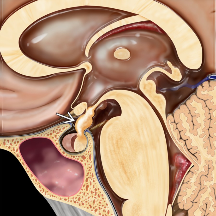 Sagittal graphic shows a pituicytoma involving the infundibular stalk  and neurohypophysis. A lobular suprasellar mass without significant compression of the adjacent structures is typical for this rare, low-grade, spindle cell glial neoplasm.