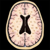 Axial graphic shows multifocal infarcts involving the cortical gray matter and subcortical white matter bilaterally.