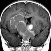 Axial T1 C+ MR in a child with a huge multilobulated craniopharyngioma shows rim  and solid nodular  enhancement. Note that the cyst fluid is moderately hyperintense compared to CSF in the lateral ventricles.
