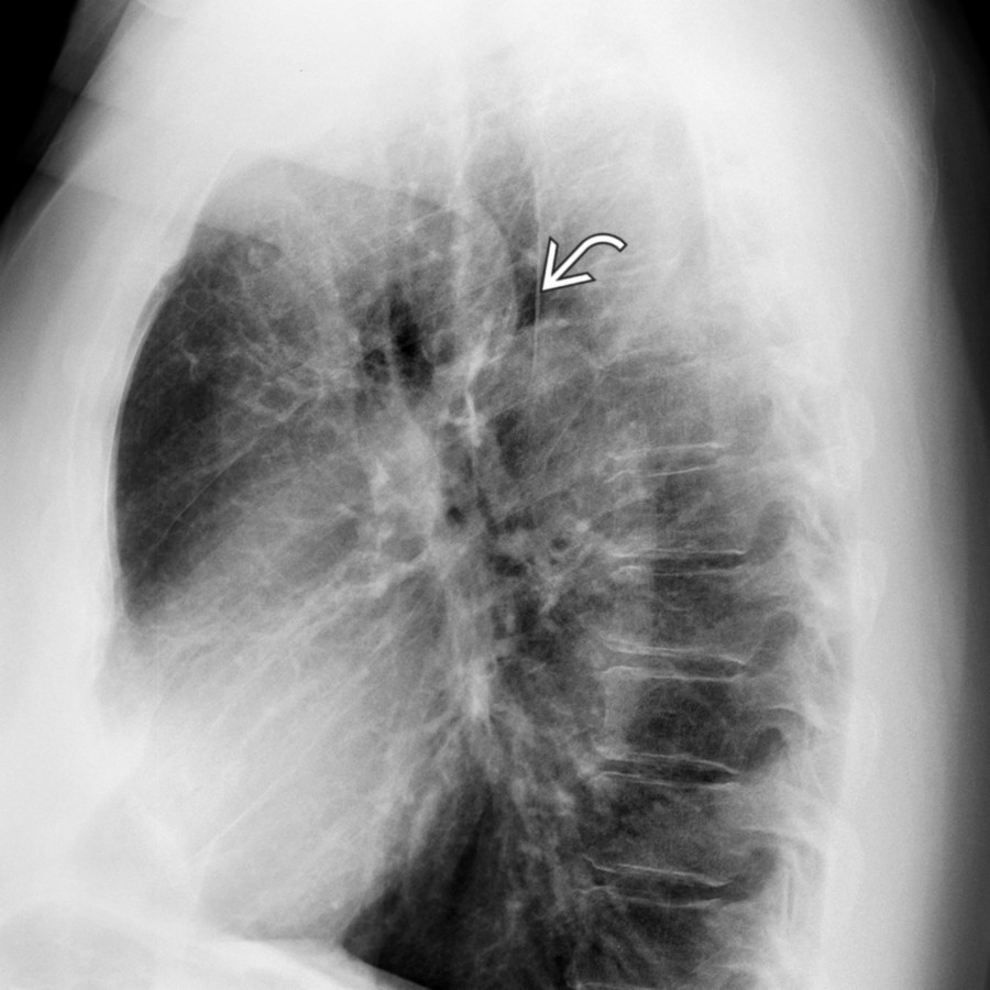 Lateral radiograph of the chest in the same patient reveals an indentation  along the aortic isthmus, representing the stenosis. While the figure 3 sign is not frequently seen, its presence suggests the diagnosis and should prompt additional evaluation.