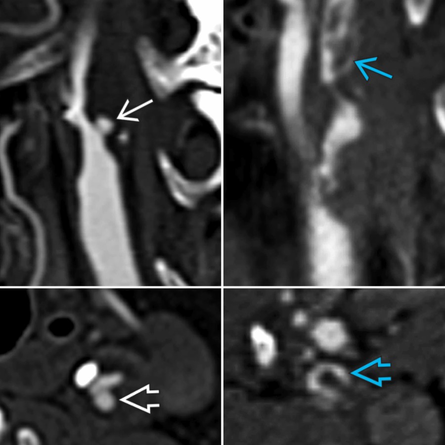 CTA (and MRA) can also detect ulceration (sagittal  and axial ) and intraluminal thrombus (sagittal  and axial ).