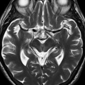 Axial T2WI MR in the same patient shows volume loss of the midbrain with thinned tectum  and concave lateral midbrain margins .